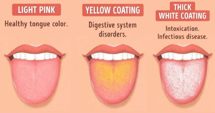 Tongue antibiotics develops